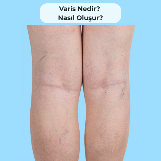 Varis Nedir? Nasıl Oluşur?