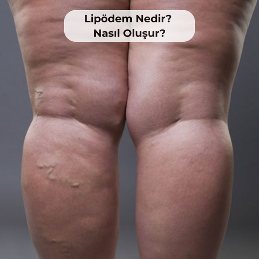 Lipödem Nedir? Nasıl Oluşur?
