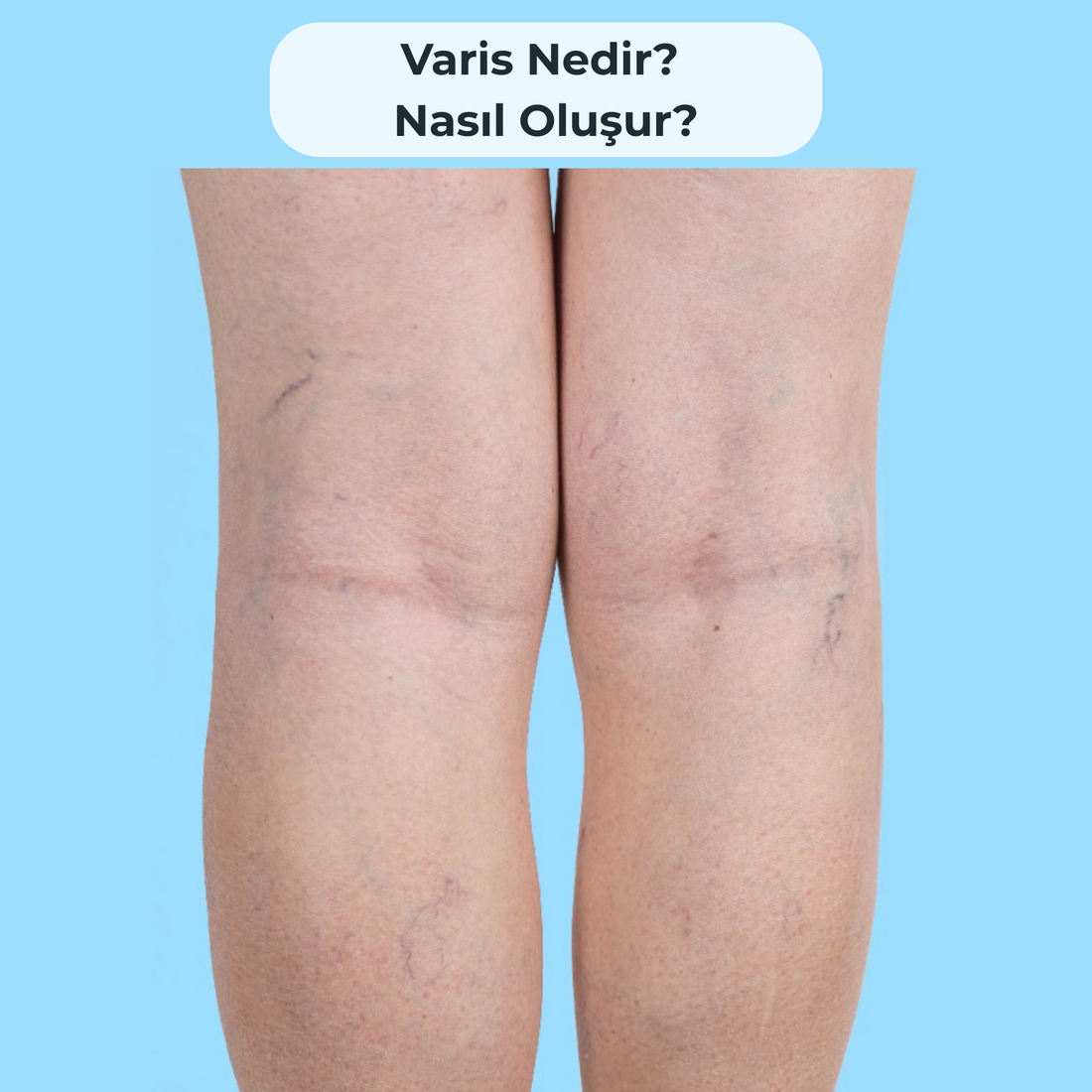 Varis Nedir? Nasıl Oluşur?